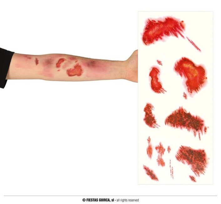 Tetovačky Umělé popáleniny